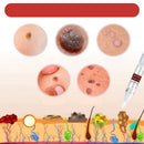 Removedor de Verrugas WipeOff™ |COMPRE 1 LEVE 2|